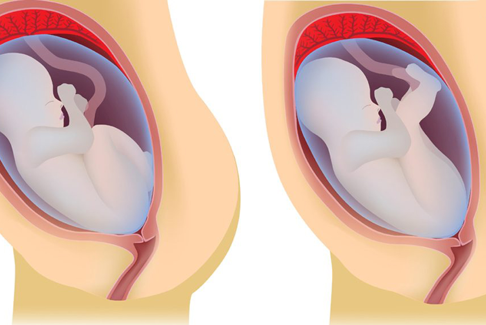 So sieht es aus, wenn ein Baby mit dem Po voran zur Welt kommt So sieht es aus, wenn ein Baby mit dem Po voran zur Welt kommt