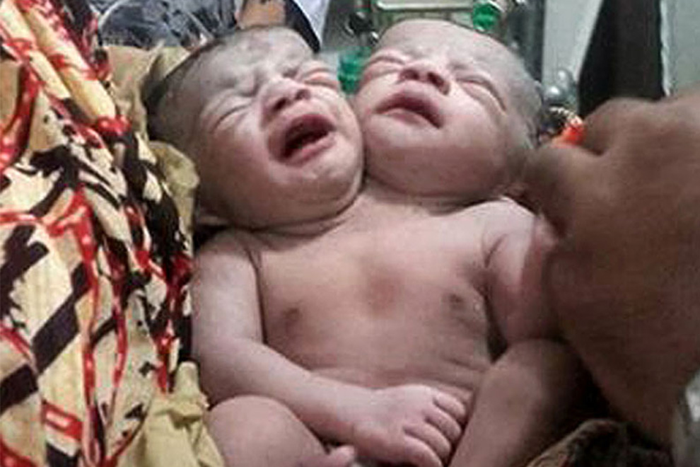 Mädchen mit zwei Köpfen in Bangladesch geboren