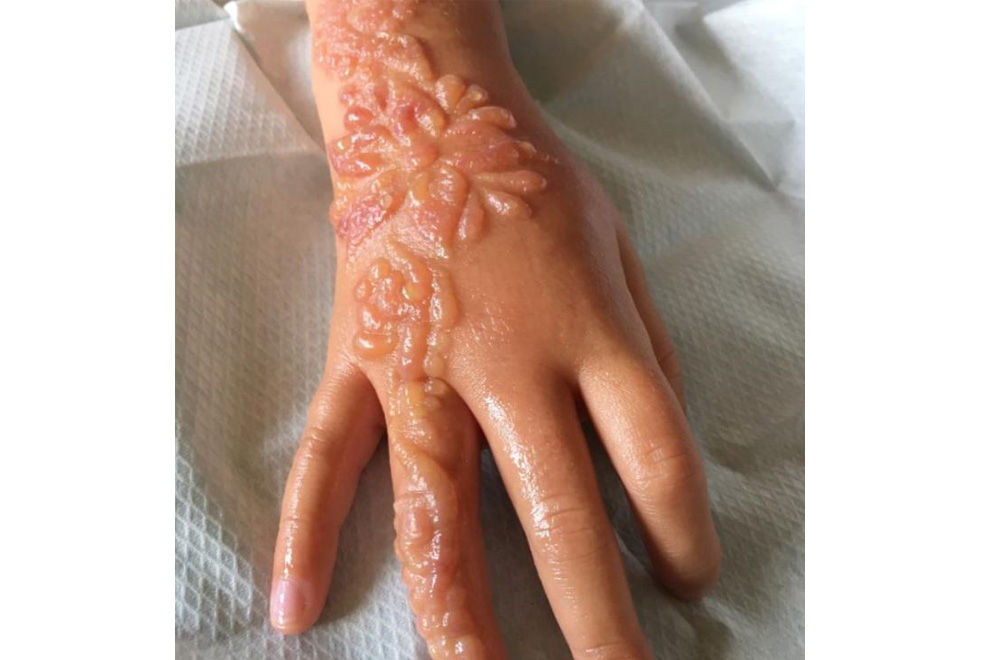 Mit Brandblasen ins Krankenhaus: Schlimme Verbrennungen durch Henna-Tattoo