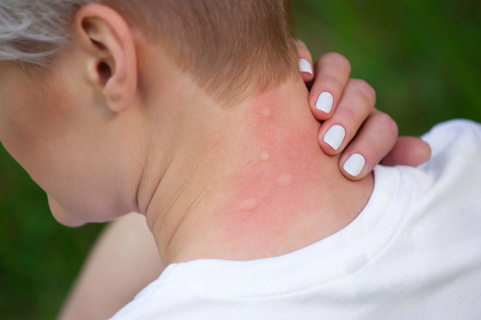 5 Gründe, warum du öfter von Mücken gestochen wirst als andere Menschen