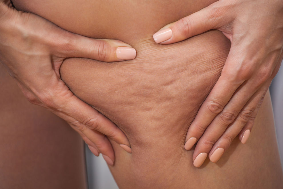 Diese 5 Köstlichkeiten verschlimmern Cellulite