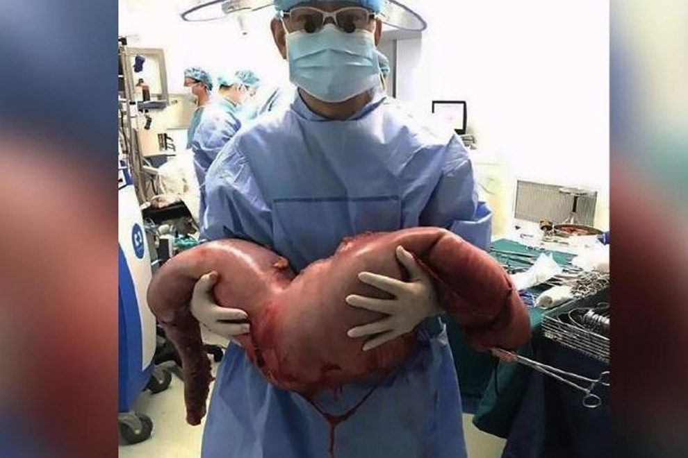 Ärzte entfernen einem jungen Chinesen 13 kg schweres Darmteil gefüllt mit Fäkalien