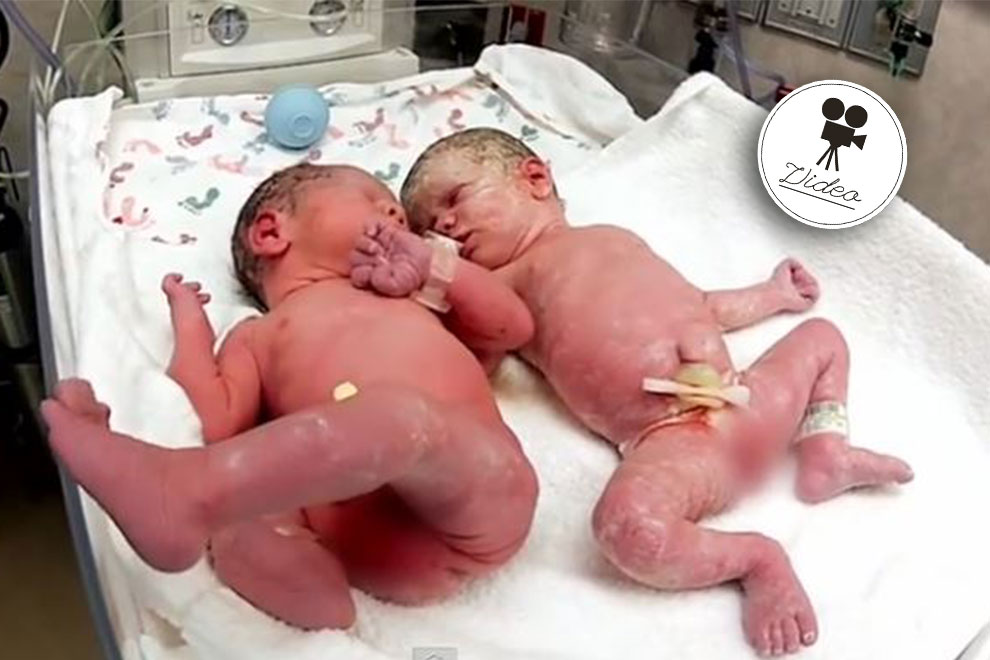 Diese Zwillinge liegen nach ihrer Geburt zum ersten Mal nebeneinander