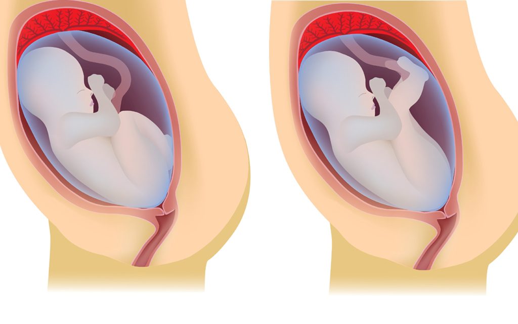 Steißgeburt: So sieht es aus, wenn ein Baby mit dem Po voran zur Welt kommt Steißgeburt: So sieht es aus, wenn ein Baby mit dem Po voran zur Welt kommt