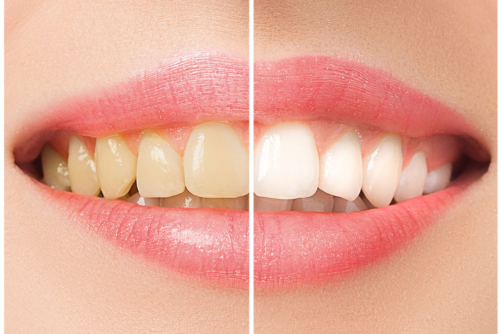 Diese 3 Obstsorten bleichen deine Zähne ganz ohne Chemie