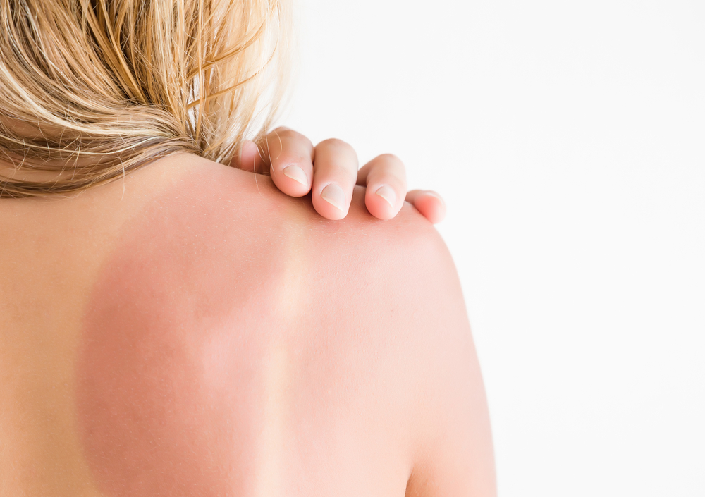 6 Tipps bei Sonnenbrand: Das hilft bei verbrannter Haut