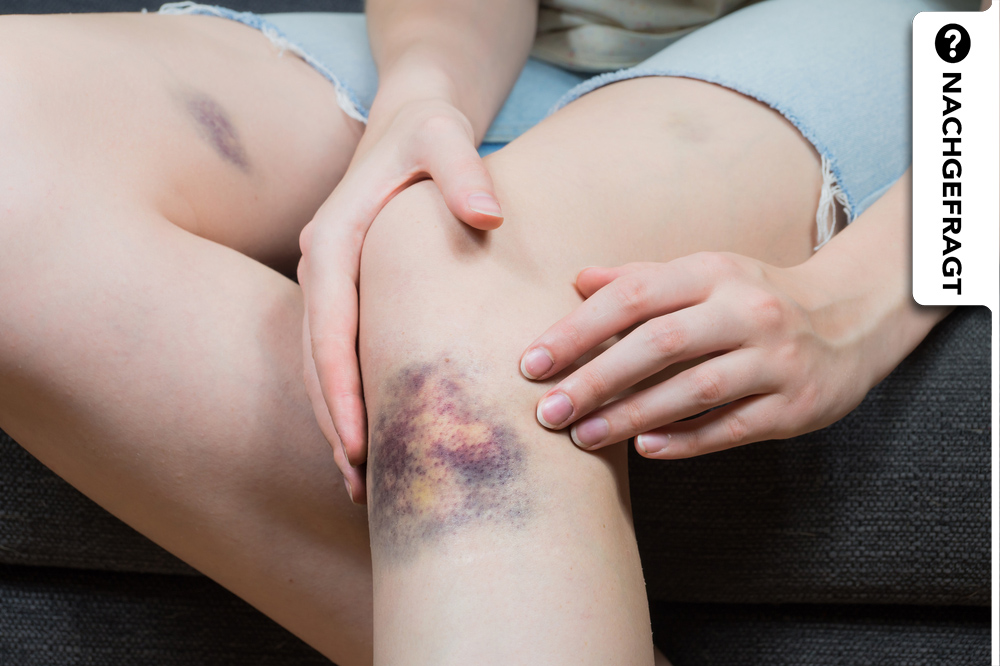 Ständig blaue Flecken: Das könnte die Ursache sein Ständig blaue Flecken: Das könnte die Ursache sein