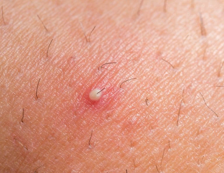 Das hilft gegen eingewachsene Haare 5 Tipps