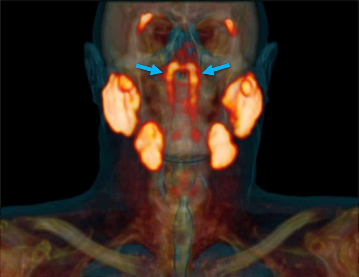 Wissenschaftler finden neues Organ im Rachenraum