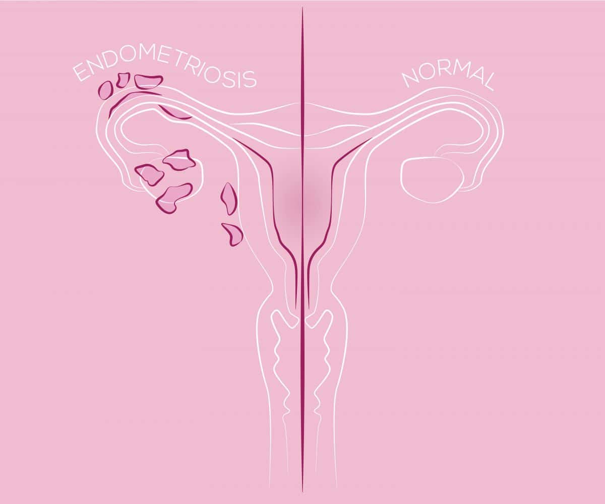 Tabuthema Frauengesundheit: Was Endometriose wirklich bedeutet
