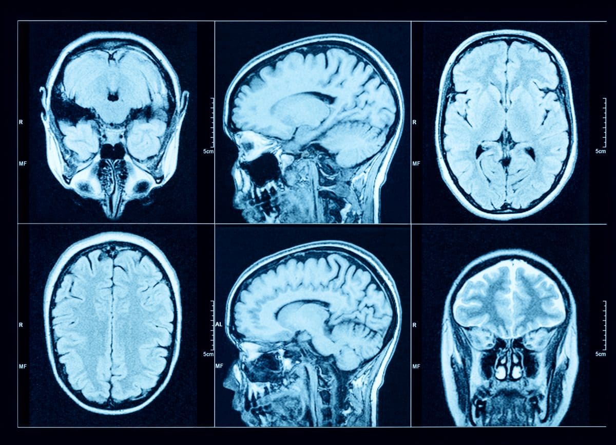 Medizin-Mysterium in den USA: 103 Fälle von Hirntumoren an einer Schule