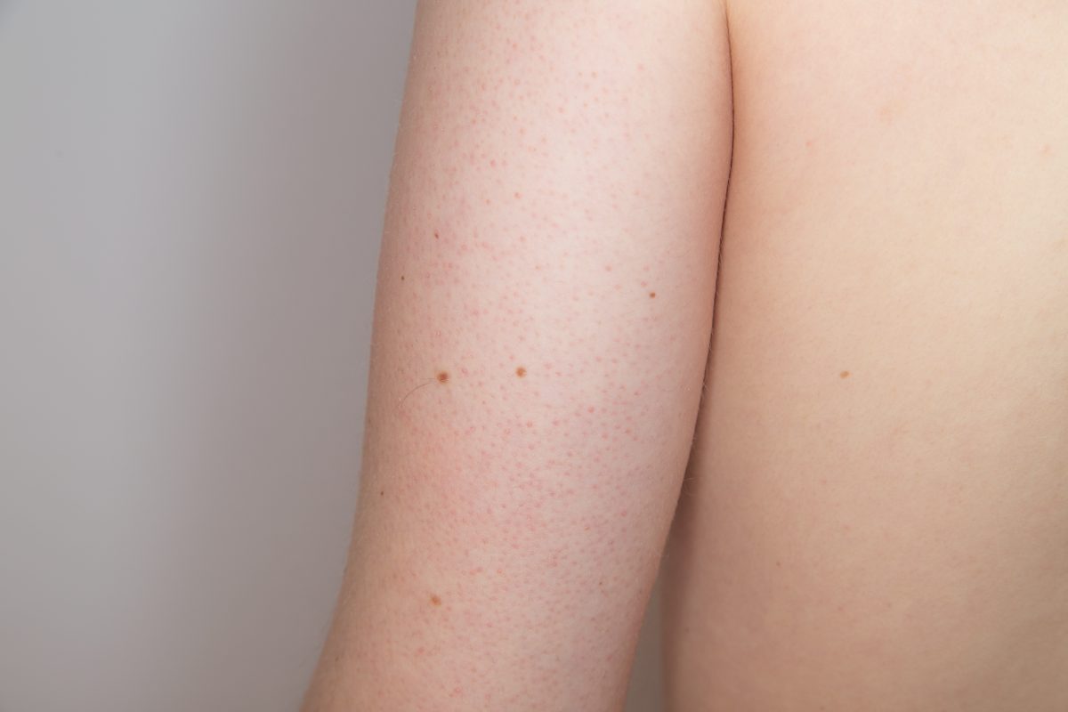 Reibeisenhaut: So wirst du sie los – mit Tipps einer Dermatologin