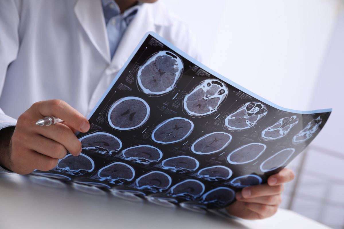 Mann klagt über Migräne: Röntgenbild zeigt Wurmeier, die sich in seinem Hirn eingenistet haben